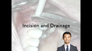 Incision and Drainage   HD 1080p