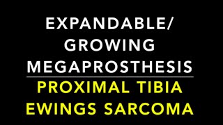 Growing Joint or Expandable Megaprosthesis for Ewing's Sarcoma Tibia