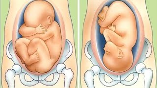 How to Determine the fetal position ? (FPD)