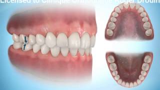 correction d'une mauvaise occlusion dentaire