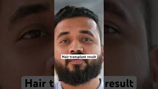 Hair transplant result #hairloss #hair #dubaiderma #hairtransplant