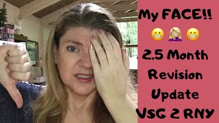 10 Week VSG to RNY Revision & Life Update! OUCH, My FACE!! 3+ Yrs Post VSG | Not Losing Weight 😬😩