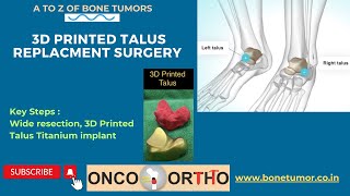 3D Printed Talus Surgery