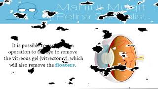 Floaters Treatment By Mahi Mukit