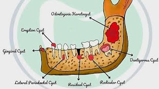 #Easy drawing of odontogenic cysts for bds exam purpose #