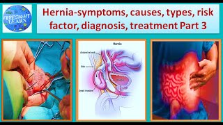 Hernia Symptoms, causes, types, Risk factor, diagnosis, treatment Part 3