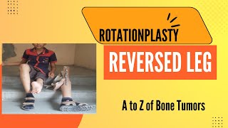 Rotationplasty