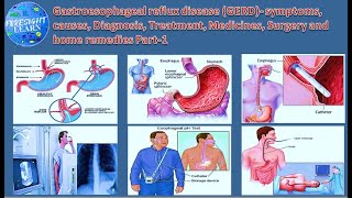 Gastroesophageal reflux disease  symptoms, causes, Diagnosis, Treatment, Medicines, Surgery part-1