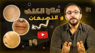 علاج الكلف والتصبغات وطريقة التخلص منه !