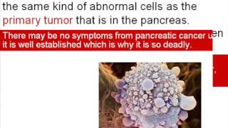 Pancreatic Cancer Prognosis