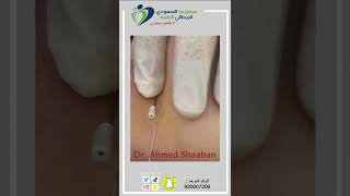 علاج خطوط الابتسامة بالخيوط