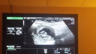 10 week ultrasound pt. 2