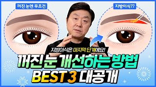 눈 위 꺼짐에도 눈썹하거상을 한다고...? 꺼진 눈 눈썹거상 고민 중이라면 이 영상 꼭 보세요! - 의학박사 백승준