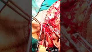 Supra_Omohyoid neck disection