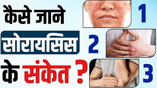 Psoriasis: Causes, Triggers and Treatment | सोरायसिस को कैसे पहचाने | Treatment of Psoriasis