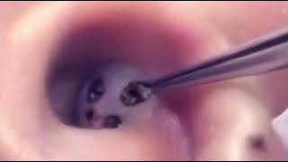 Removing large blackheads from the ear