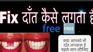 fix dant kaise lagate hain | #dentist #youtubevideo