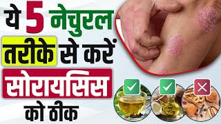 Psoriasis permanently treatment in India | ये 5 नेचुरल तरीके से करें सोरायसिस को ठीक