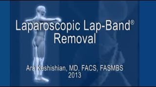 Laparoscopic Lap-Band® Removal