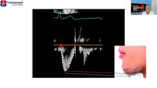 Aula sobre fluxo mitral