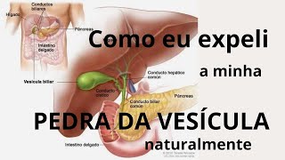 Pedras na vesícula biliar - Livre-se delas sem cirurgia.