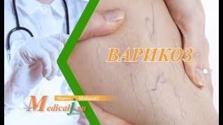 Варикоз. Какие причины, симптомы, как лечить?