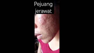 buat pejuang jerawat. semangat 💪💪 tetap kuat #acne #acnescars #pejuangjerawat