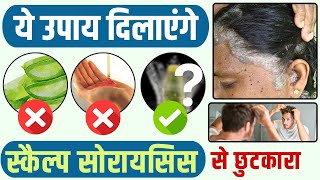 स्कैल्प सोरायसिस के लिए घरेलू उपाय | Best Home Remedy For Scalp Psoriasis in India |