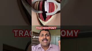 Tracheostomy