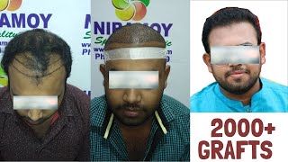 Hair Transplant Success Story | Feedback |