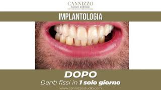 Estetica Dentale e Implantologia Prima e Dopo - Dr. Cannizzo