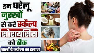 घरेलू उपाय से करें स्कैल्प सोरायसिस को ठीक | Hair psoriasis removal | Psoriasis ka ilaj