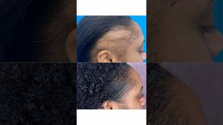 Hair Transplant for Patient with Traction Alopecia