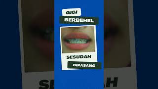 Pasang Behel Gigi