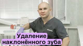 #одномоментнаяимплантация #osstem #strautmann Удаление наклоненного зуба, имплантация осстем.