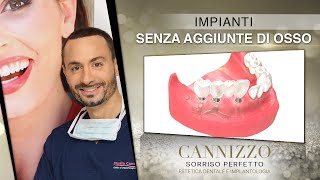 Implantologia Senza Osso: Impianti a Griglia - Dr. Cannizzo