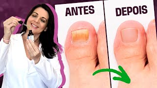 UNHAS DOENTES | Solução natural e receita caseira para tratar