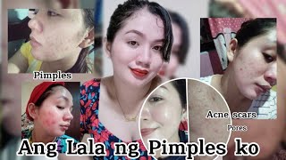 Bye big PORES || Paano Nawala ang Acne & Acne Scars ko ll Effective Rejuvenating Set in Just 7 days