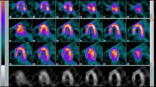 Gammagrama SPECT Cardiaco