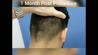 Scar-less FUE hair transplant by Dr Harold Ma