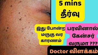 Dermatologist tips to prevent and remove marugu/moles/ DPN #dpnremoval  #macham #marugu