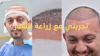 تجربتي مع زراعة الشعر