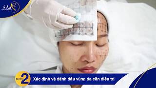 Quy trình trẻ hóa da với New Thermage 2019