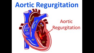 Heart's Leaky Faucet: Understanding Aortic Regurgitation