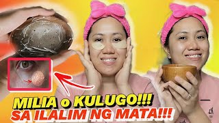 MILIA TREATMENT at HOME o KULUGO SA ILALIM NG MATA PAANO KO INAAGAPAN SUPER EFFECTIVE ITO!