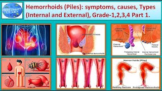 Hemorrhoids Piles Symptoms, causes, types, grade