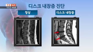 부산본병원 KNN건강 365 [숨은 척추질환, 디스크 내장증]