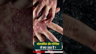 Psoriasis vs eczema in hindi | सोरायसिस और एक्जिमा में क्या अंतर है | Skin ka problem #shorts