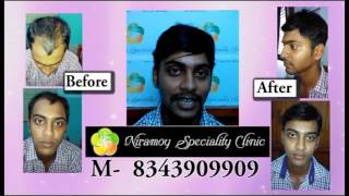 Non Surgical Hair Replacement in Kolkata | নকল চুল প্রতিস্থাপন | Niramoy