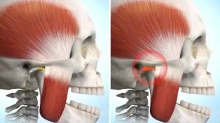 Trouble ATM (articulation temporo-mandibulaire)